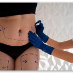 cirugía bariátrica